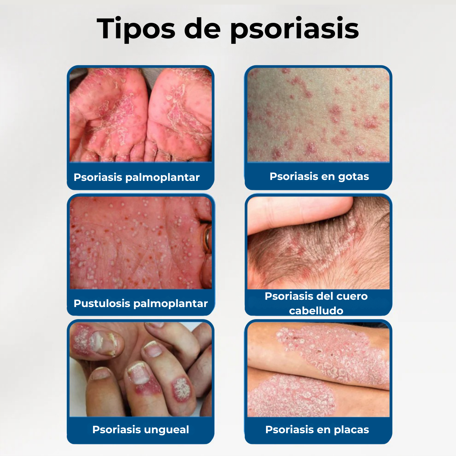 Dermocap® Crema ⎜ Para un cuero cabelludo y una piel suave y calmada